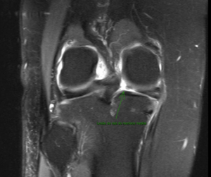 Lesão da raiz do menisco medial